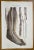 Diseases of the Arteries is a lithograph hand colored by Ottavio Muzzi for the edition of Antoine Chazal, Human Anatomy,...
