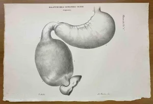 Ottavio Muzzi, Small Intestine Disease, Lithograph, 1843