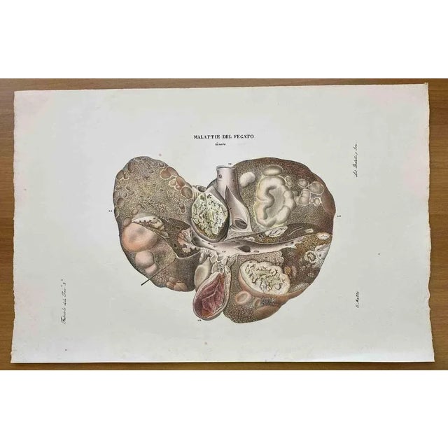 Liver Disease is a lithograph hand colored by Ottavio Muzzi for the edition of Antoine Chazal, Human Anatomy, Printers...