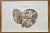 Liver Disease is a lithograph hand colored by Ottavio Muzzi for the edition of Antoine Chazal, Human Anatomy, Printers...