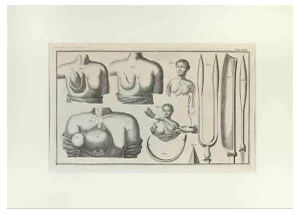 Lorenz Heister, Surgical Instruments, Etching, 1750