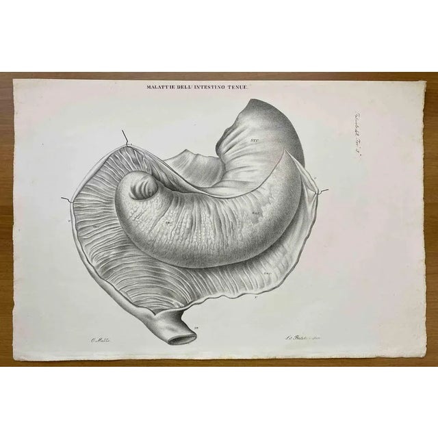 Small Intestine Disease is a lithograph hand colored by Ottavio Muzzi for the edition of Antoine Chazal, Human Anatomy,...