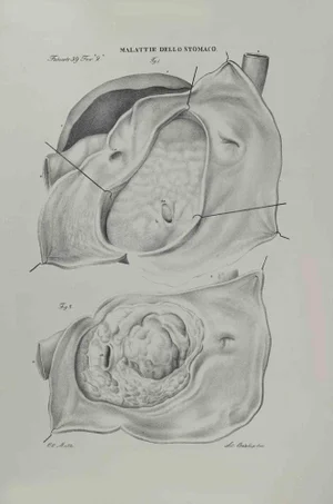 Ottavio Muzzi, Stomach Diseases, Lithograph, 1843