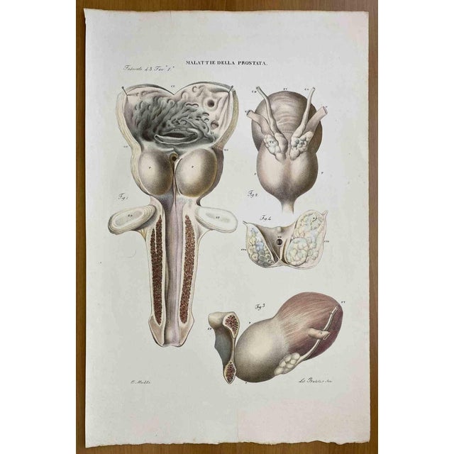 Ottavio Muzzi, Prostate Diseases, Lithograph, 1843 For Sale