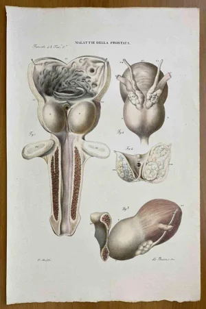 Ottavio Muzzi, Prostate Diseases, Lithograph, 1843