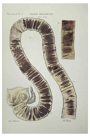 Ottavio Muzzi, Bowel Diseases, Lithograph, 1843