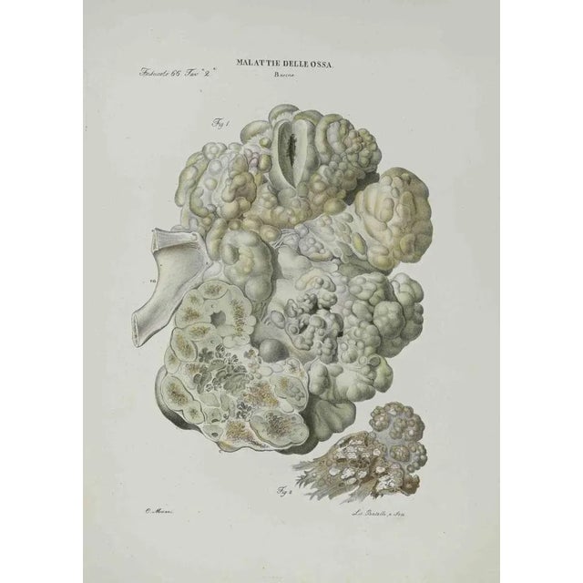 Bone Disease is a lithograph hand colored by Ottavio Muzzi for the edition of Antoine Chazal, Human Anatomy, Printers...