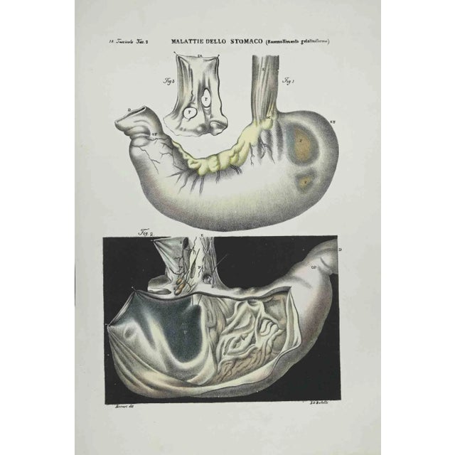 Stomach Diseases is a lithograph hand colored by Ottavio Muzzi for the edition of Antoine Chazal, Human Anatomy, Printers...