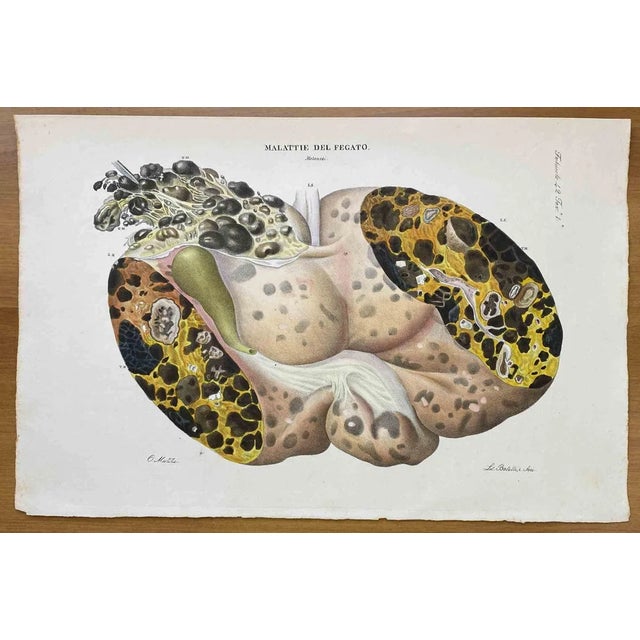 Ottavio Muzzi, Liver Disease, Lithograph, 1843 For Sale