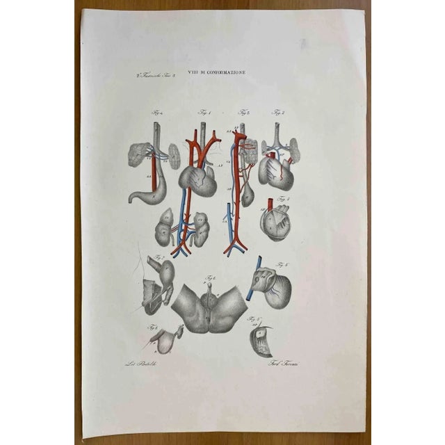 Conformation Defects is a lithograph hand colored by Ottavio Muzzi for the edition of Antoine Chazal, Human Anatomy,...