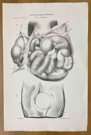 Ottavio Muzzi, Intestinal Diseases, Lithograph, 1843