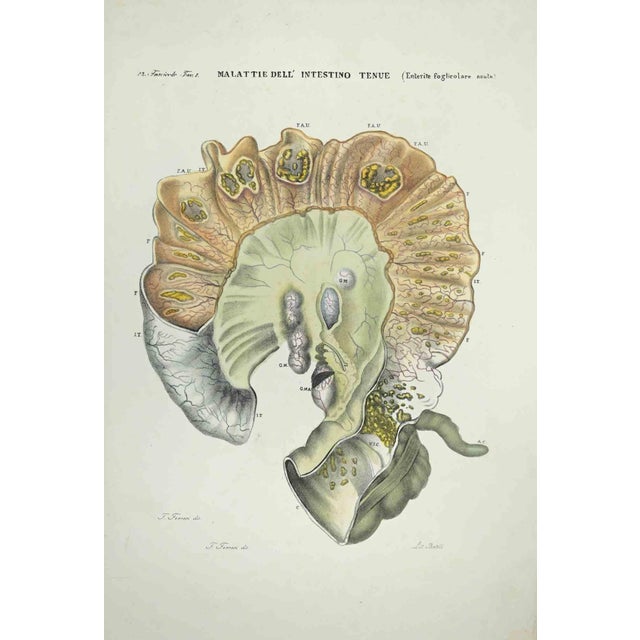 Diseases of the Small Intestine is a lithograph hand colored by Ottavio Muzzi for the edition of Antoine Chazal, Human...