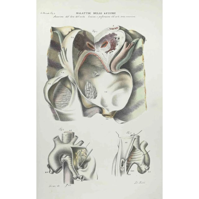 Diseases of the Arteries is a lithograph hand colored by Ottavio Muzzi for the edition of Antoine Chazal, Human Anatomy,...