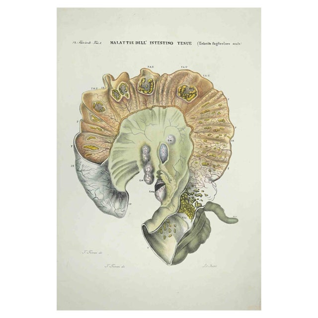 Ottavio Muzzi, Diseases of the Small Intestine, Lithograph, 1843 For Sale