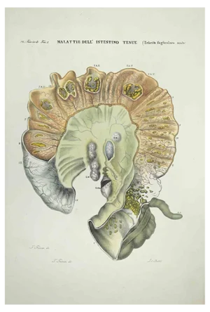 Ottavio Muzzi, Diseases of the Small Intestine, Lithograph, 1843