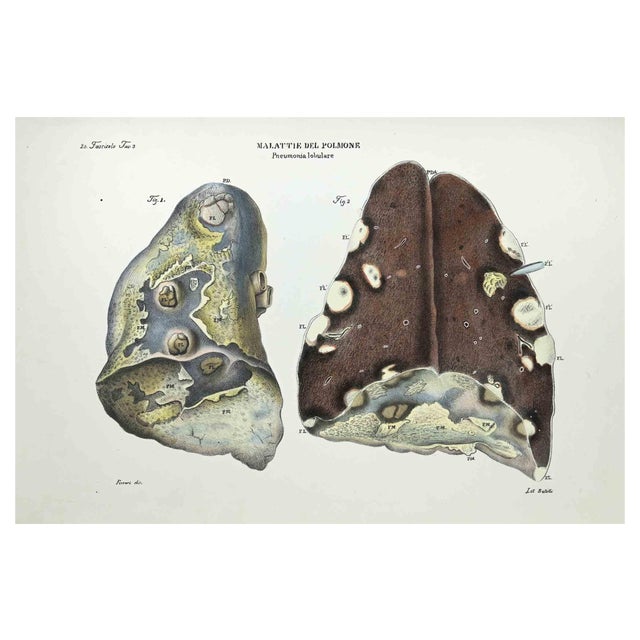 Ottavio Muzzi, Lung Diseases, Lithograph, 1843 For Sale