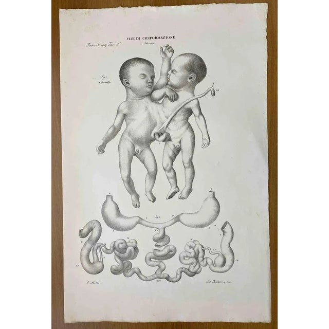 Conformation Defects is a lithograph hand colored by Ottavio Muzzi for the edition of Antoine Chazal, Human Anatomy,...
