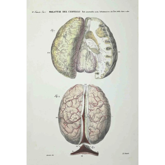 Brain Diseases is a lithograph hand colored by Ottavio Muzzi for the edition of Antoine Chazal, Human Anatomy, Printers...