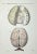 Brain Diseases is a lithograph hand colored by Ottavio Muzzi for the edition of Antoine Chazal, Human Anatomy, Printers...