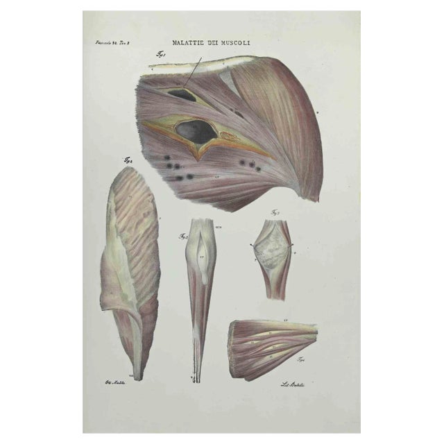 Ottavio Muzzi, Muscles Diseases, Lithograph, 1843 For Sale