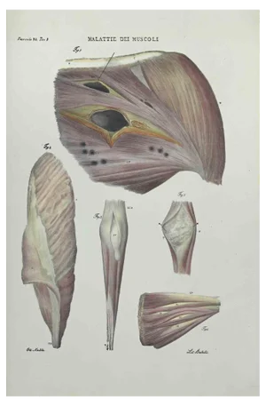 Ottavio Muzzi, Muscles Diseases, Lithograph, 1843