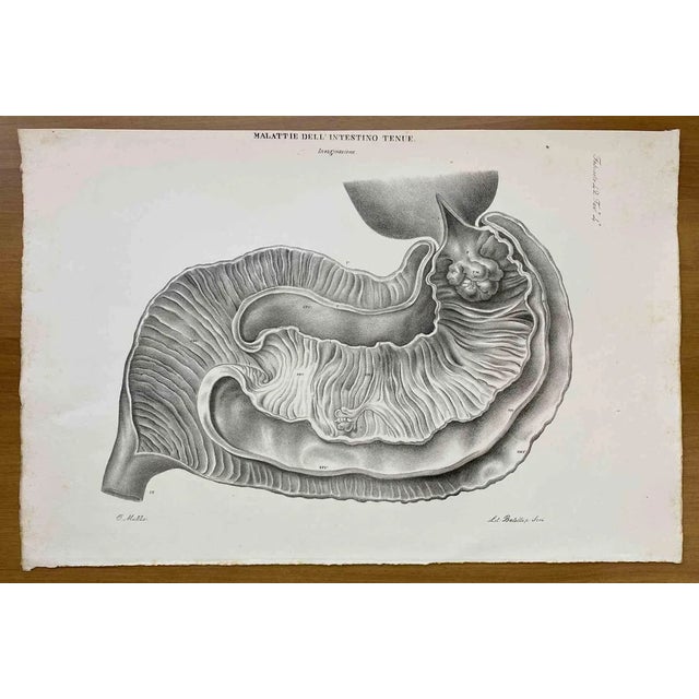 Ottavio Muzzi, Small Intestine Disease, Lithograph, 1843 For Sale