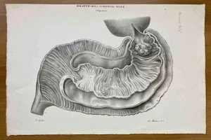 Ottavio Muzzi, Small Intestine Disease, Lithograph, 1843