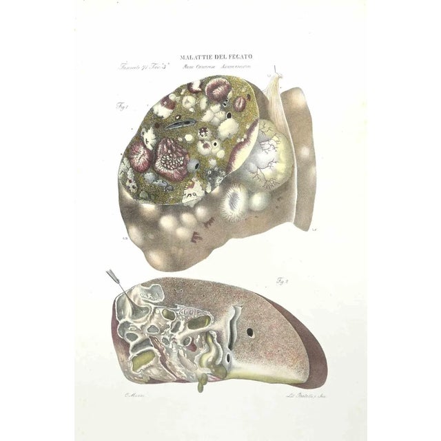 Liver Diseases is a lithograph hand colored by Ottavio Muzzi for the edition of Antoine Chazal,Human Anatomy, Printers...