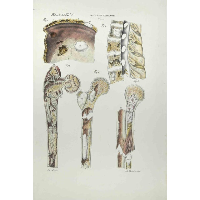 Bone Diseases is a lithograph hand colored by Ottavio Muzzi for the edition of Antoine Chazal,Human Anatomy, Printers...