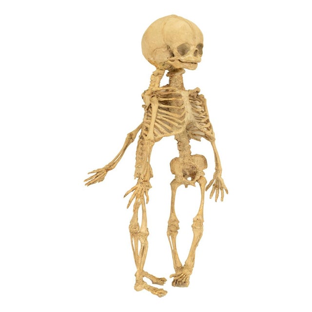 Antique 19thC Anatomical Conjoined Syncephalus Twins Skeleton Medical Model 1860 For Sale - Image 16 of 17