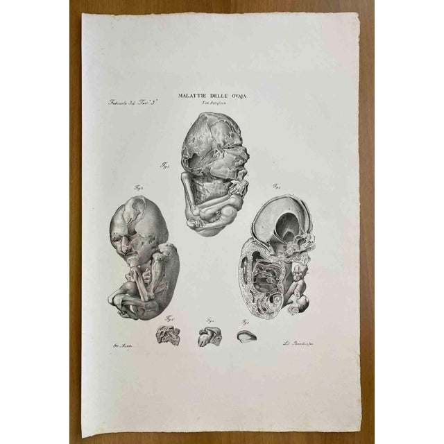 Diseases of the Ovary is a lithograph hand colored by Ottavio Muzzi for the edition of Antoine Chazal, Human Anatomy,...