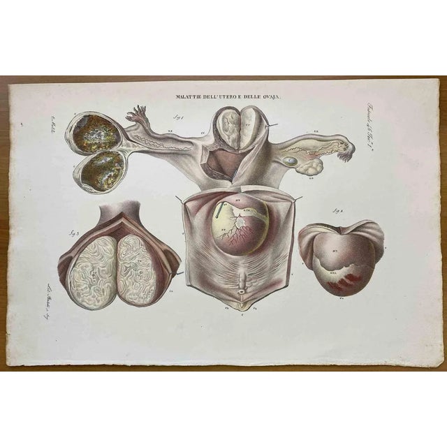 Ottavio Muzzi, Diseases of Uterus, Lithograph, 1843 For Sale