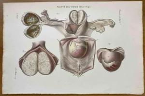 Ottavio Muzzi, Diseases of Uterus, Lithograph, 1843