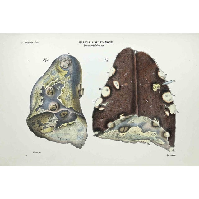 Lung Diseases is a lithograph hand colored by Ottavio Muzzi for the edition of Antoine Chazal,Human Anatomy, Printers...