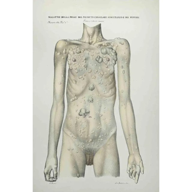 Skin Diseases of Subcutaneous Cell Tissue and Muscles is a lithograph hand colored by Ottavio Muzzi for the edition of...