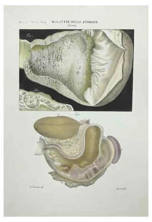 Ottavio Muzzi, Stomach Diseases, Lithograph, 1843