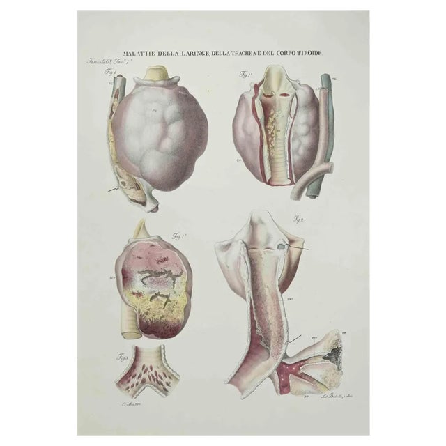 Ottavio Muzzi, Diseases of the Larynx, Trachea and Thyroid, Lithograph, 1843 For Sale