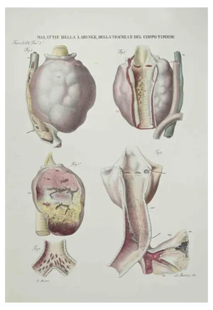 Ottavio Muzzi, Diseases of the Larynx, Trachea and Thyroid, Lithograph, 1843