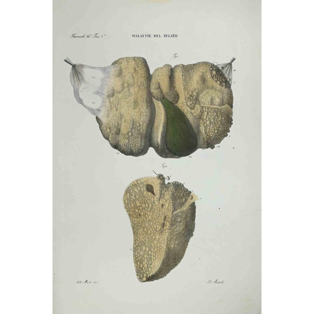 Liver Diseases is a lithograph hand colored by Ottavio Muzzi for the edition of Antoine Chazal, Human Anatomy, Printers...