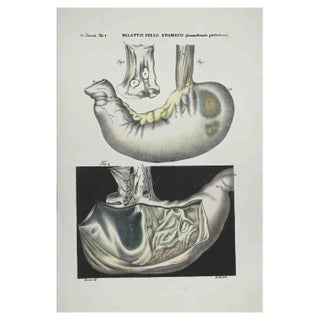 Ottavio Muzzi, Stomach Diseases, Lithograph, 1843 For Sale
