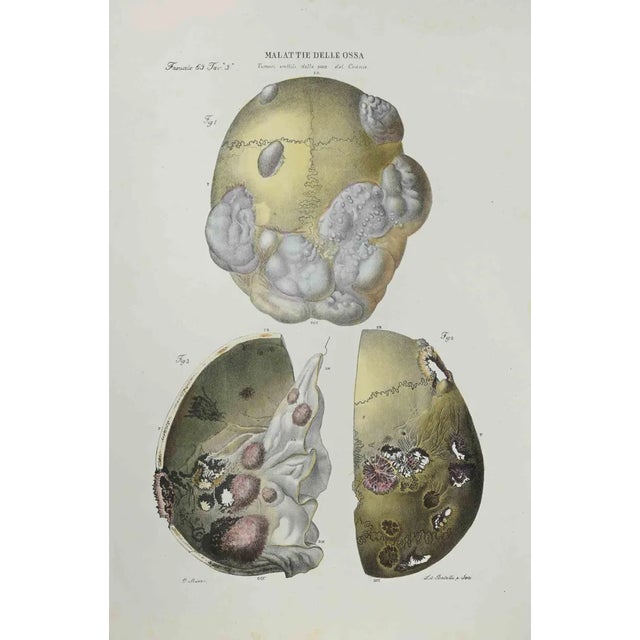 Ottavio Muzzi, Bone Disease, Lithograph, 1843 For Sale