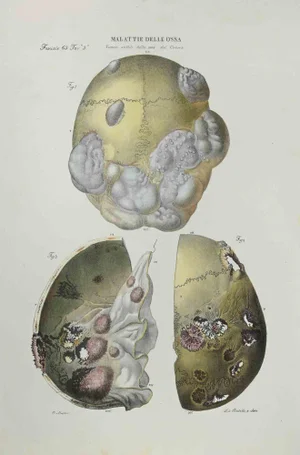 Ottavio Muzzi, Bone Disease, Lithograph, 1843