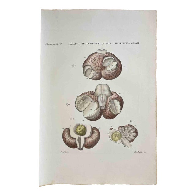 Ottavio Muzzi, Diseases of the Cerebellum, Lithograph, 1843 For Sale