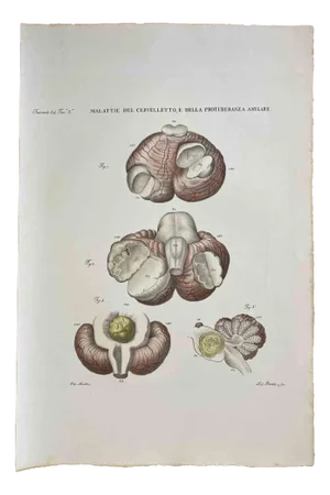 Ottavio Muzzi, Diseases of the Cerebellum, Lithograph, 1843