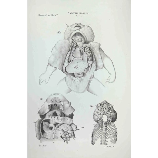 Fetus Diseases is a lithograph hand colored by Ottavio Muzzi for the edition of Antoine Chazal,Human Anatomy, Printers...