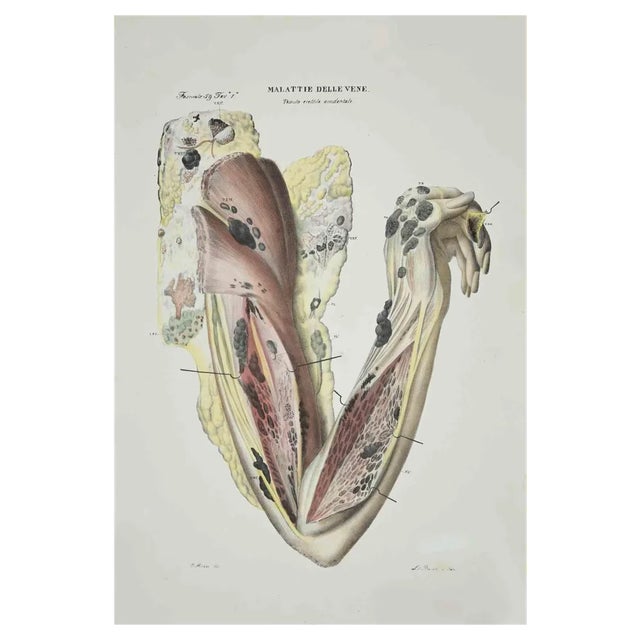 Ottavio Muzzi, Vein Diseases, Lithograph, 1843 For Sale