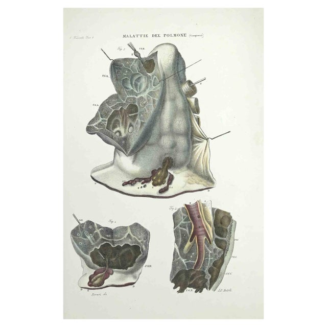 Ottavio Muzzi, Lung Diseases, Lithograph, 1843 For Sale