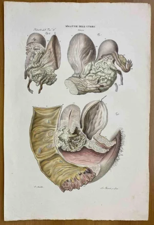 Ottavio Muzzi, Diseases of Uterus, Lithograph, 1843