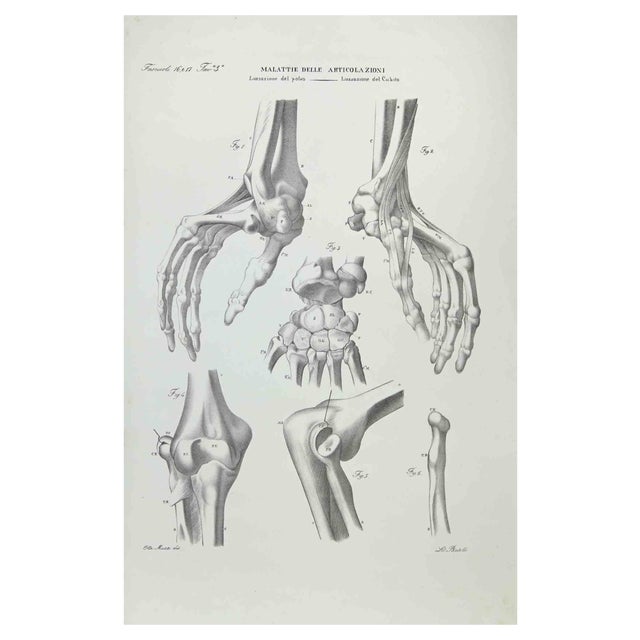 Ottavio Muzzi, Joint Diseases, Lithograph, 1843 For Sale