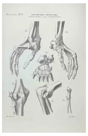 Ottavio Muzzi, Joint Diseases, Lithograph, 1843